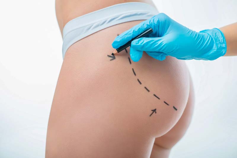 Cirurgia plástica: quais as possibilidades? 2 bioplastia de bumbum