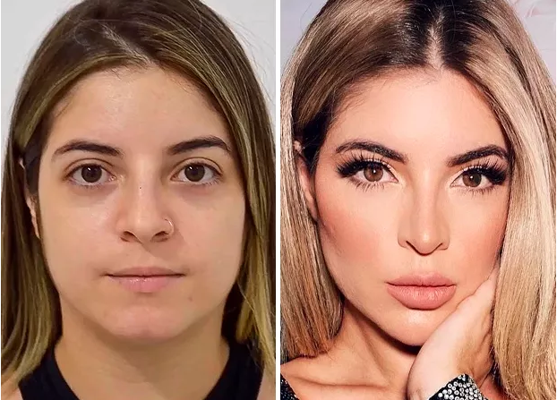 Cirurgia plástica: quais as possibilidades? 3 harmonização facial